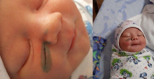 Doğum sırasında bebeğin yüzünü kestiler! - Resim : 1