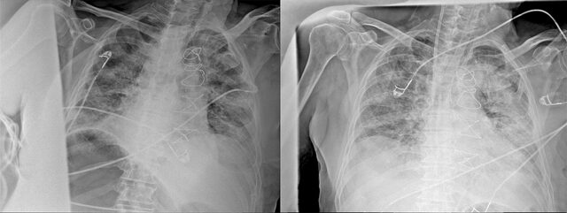 Koronavirüsün akciğerdeki ağır tahribatı tomografi görüntülerine yansıdı - Resim : 3