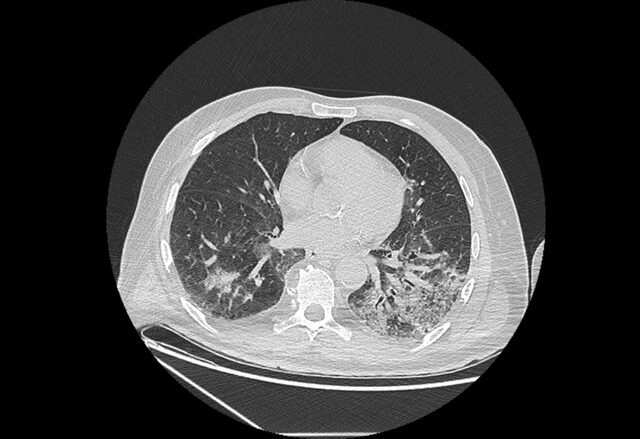 Koronavirüsün akciğerdeki ağır tahribatı tomografi görüntülerine yansıdı - Resim : 2