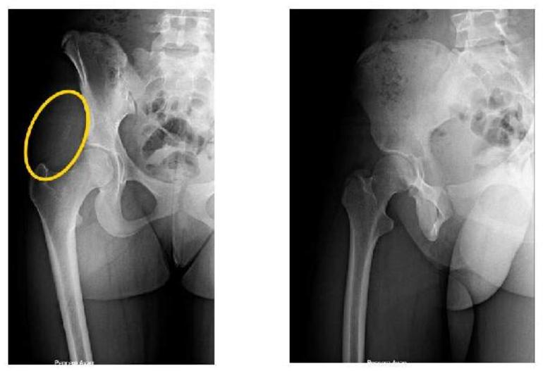 Röntgende görülmedi 15 ay kalçasında kaldı - Resim : 2