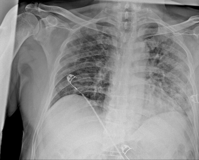 Koronavirüsün akciğerdeki ağır tahribatı tomografi görüntülerine yansıdı - Resim : 1