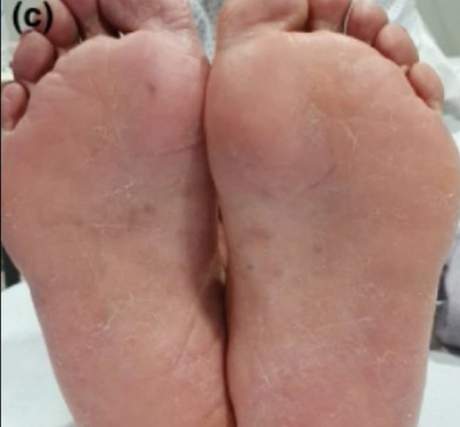 İşte mutasyona uğramış koronavirüsün yeni belirtileri - Resim : 3