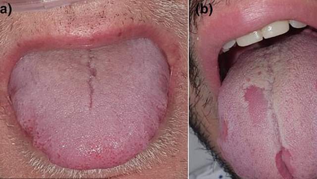 İşte mutasyona uğramış koronavirüsün yeni belirtileri - Resim : 2